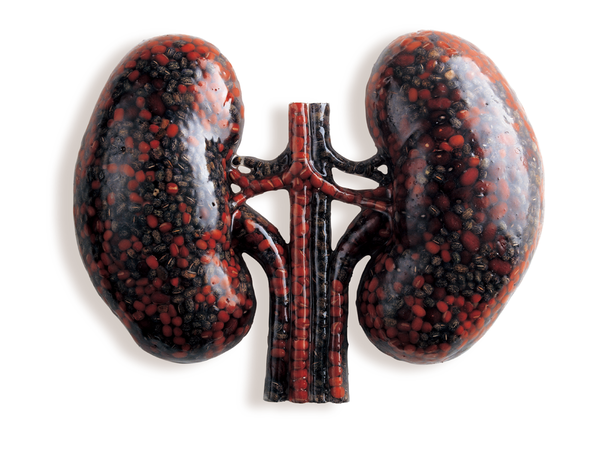 이동재, 콩팥, 투명수지에 콩과 팥, 25x29×4.5cm, 2003